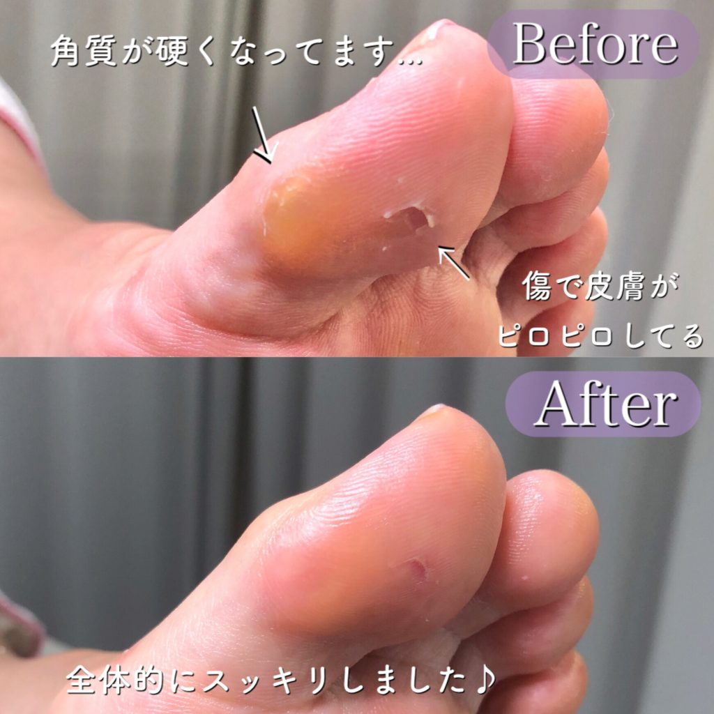 親指の角質 Foot Care Salon Runka