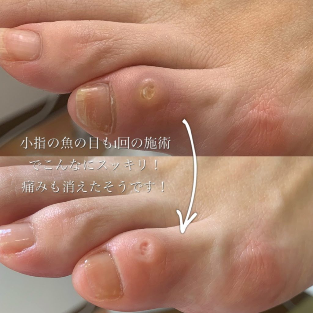 小指の魚の目 Foot Care Salon Runka