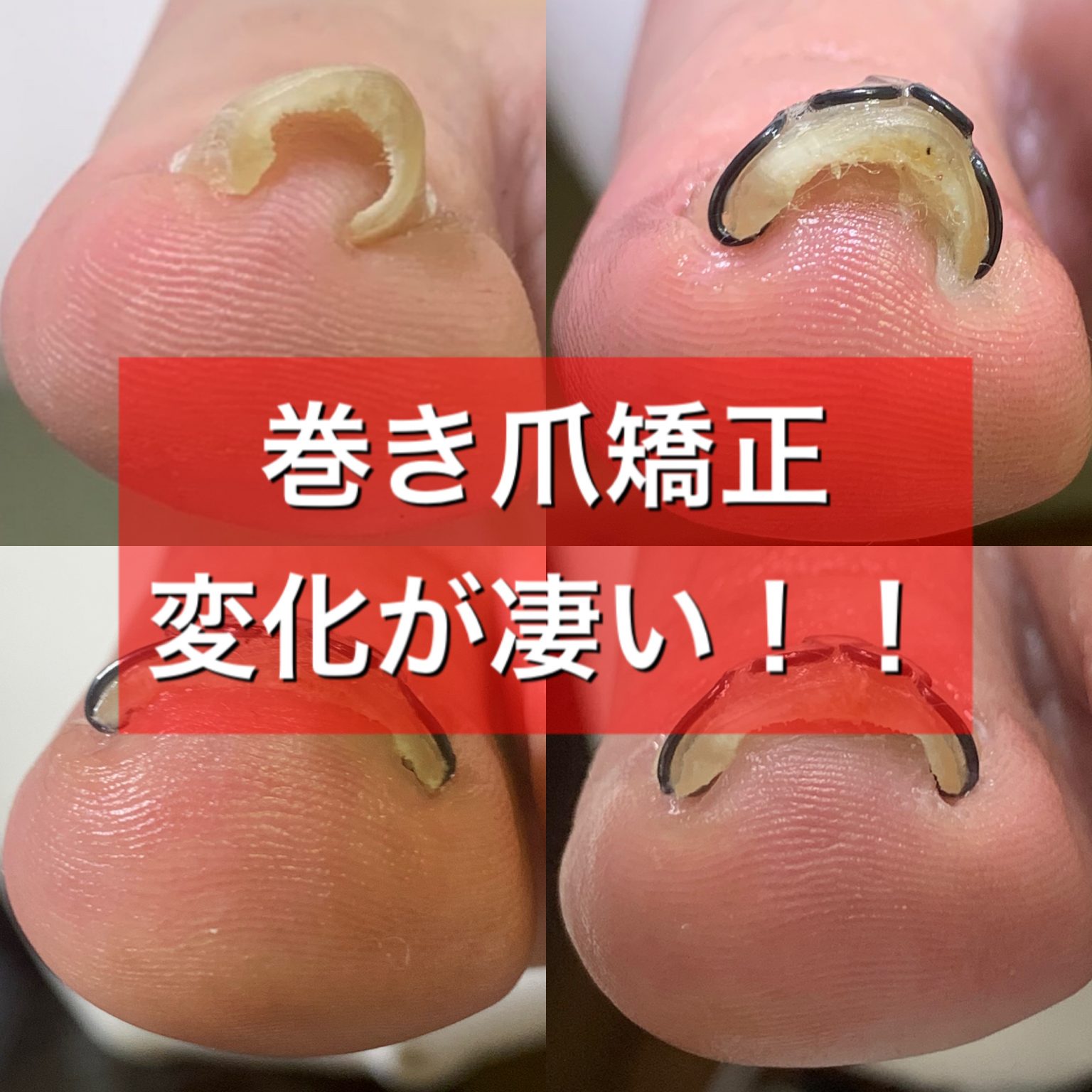 Foot Care RUNKA｜フットケア ランカ｜銀座巻き爪矯正センター