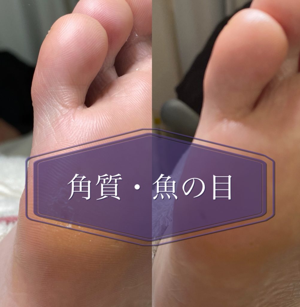 角質 魚の目 Foot Care Salon Runka