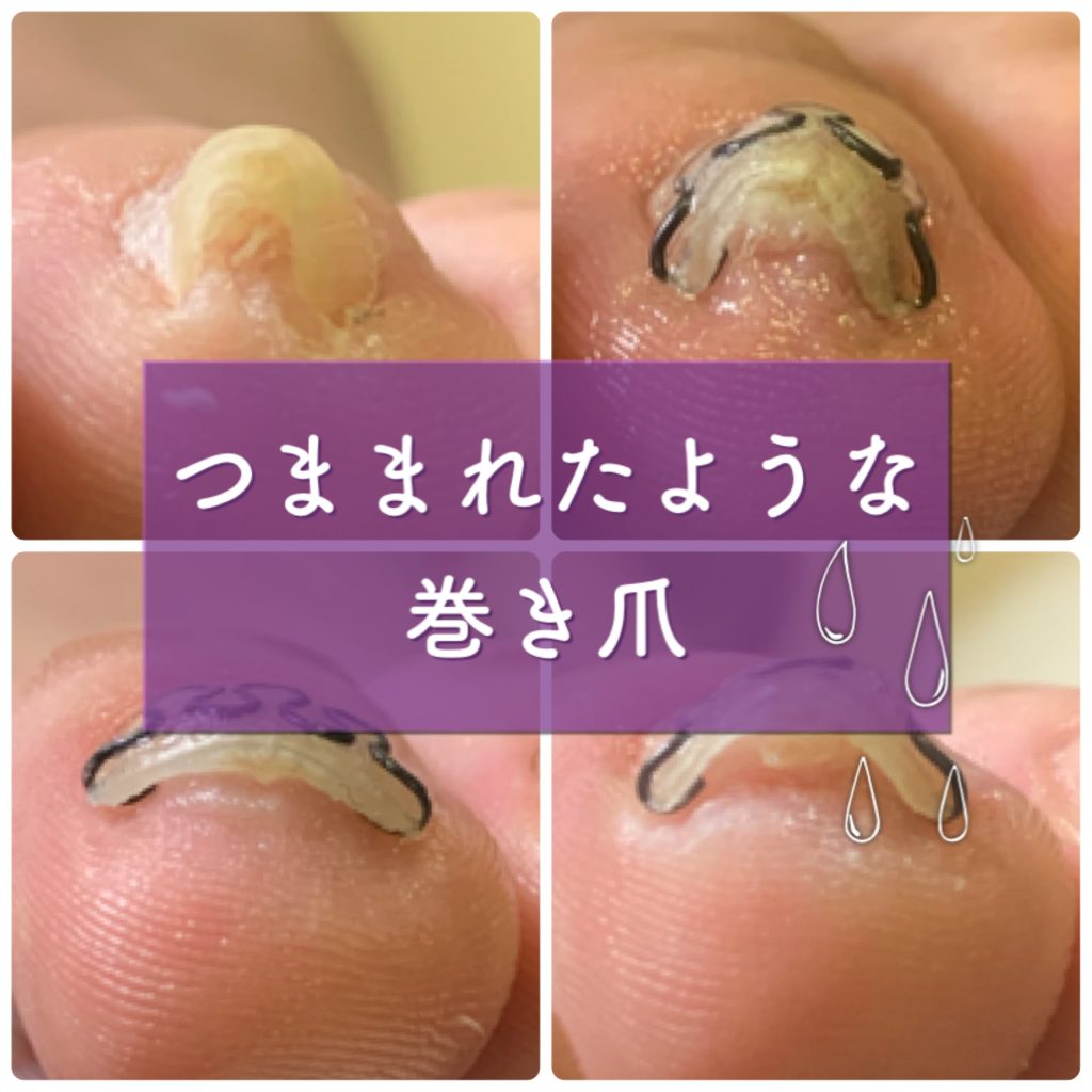 巻き爪 Foot Care Salon Runka